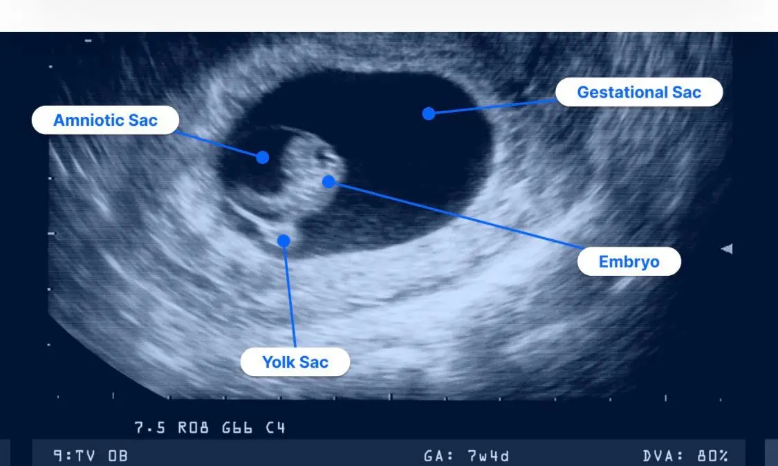 Annotated Ultrasound