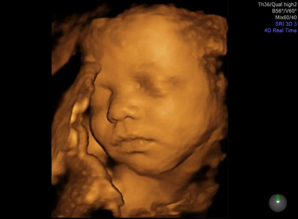 3D Ultrasound Preview